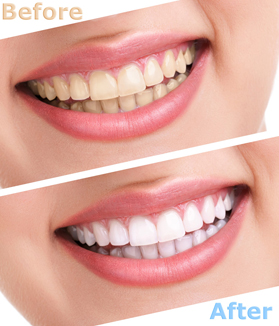 before-after-whitening