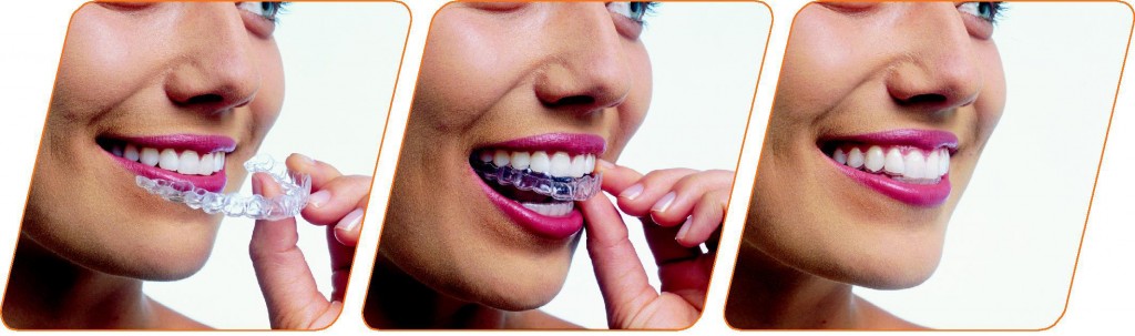 invisalign-how-it-works