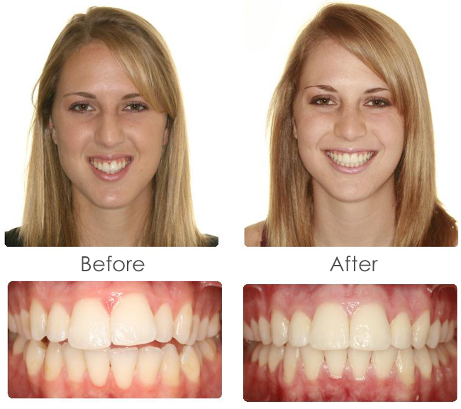 before-after-brace